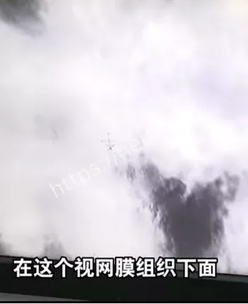 超视觉假体