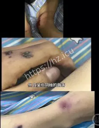 家属揭螺丝刀贯穿